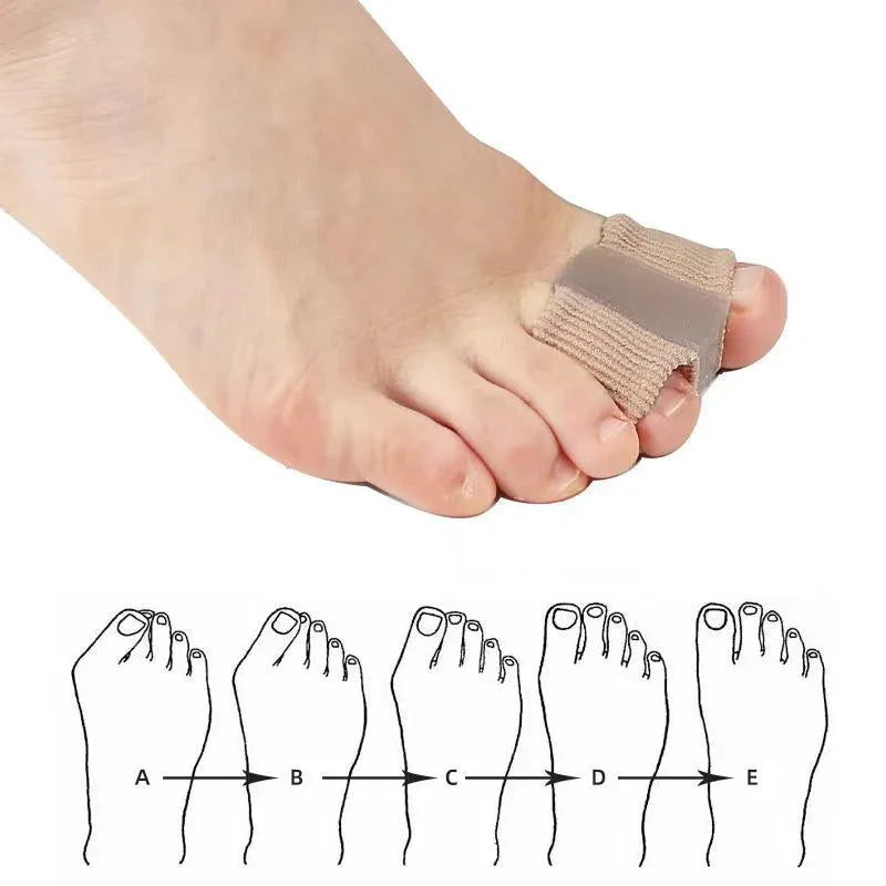 Toe straightener splint on foot for bunion correction, with foot shape chart below.