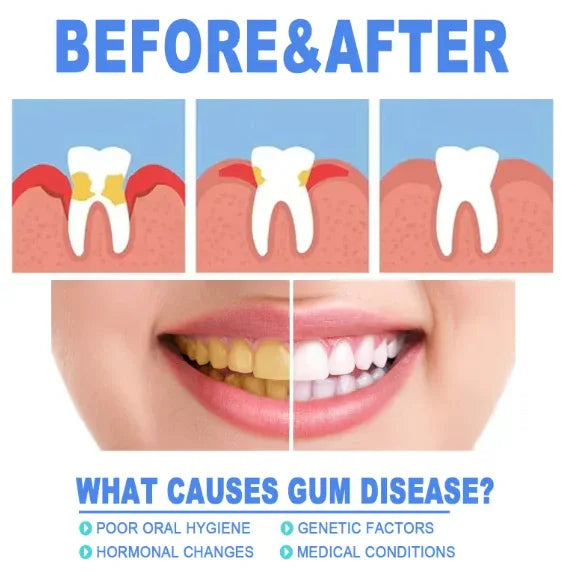 Before and after gum disease illustration, split smile showing stained and white teeth, causes of gum disease listed.